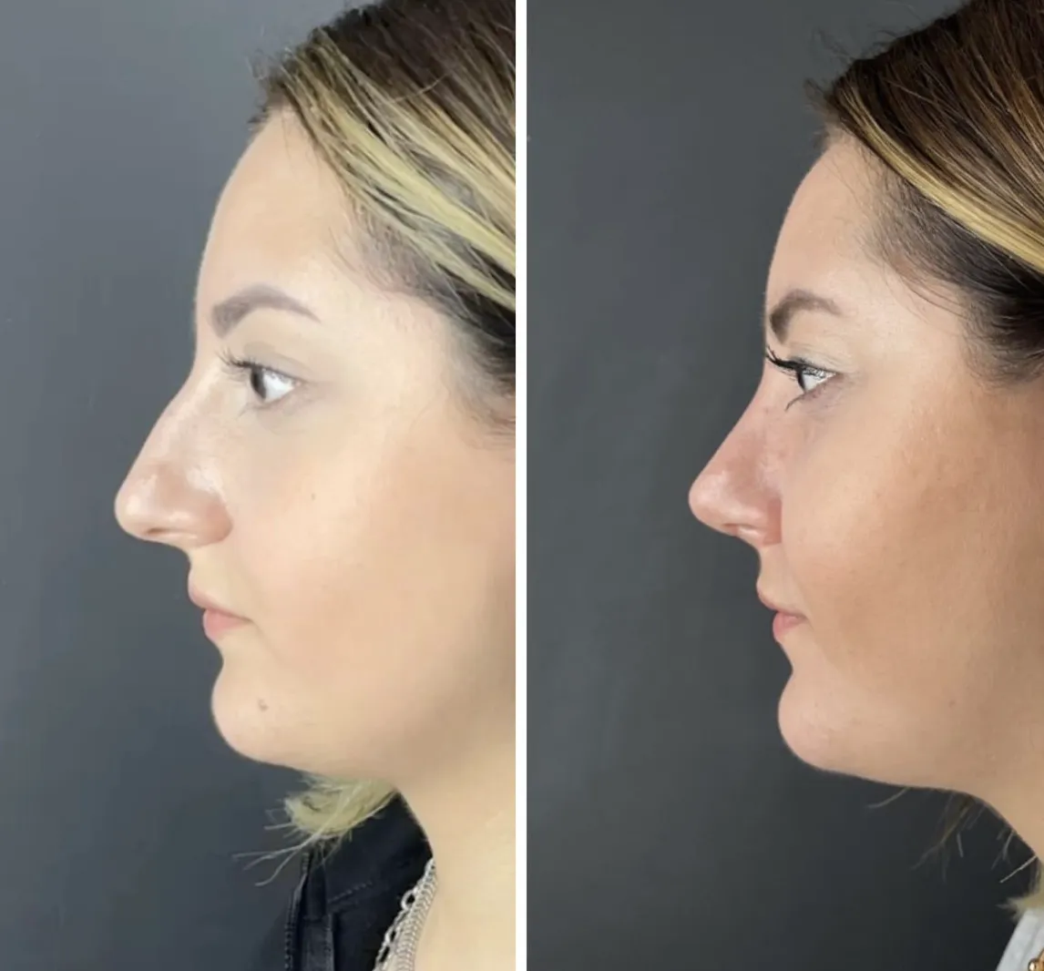 Closed rhinoplasty before after - natural nose reshaping Turkey